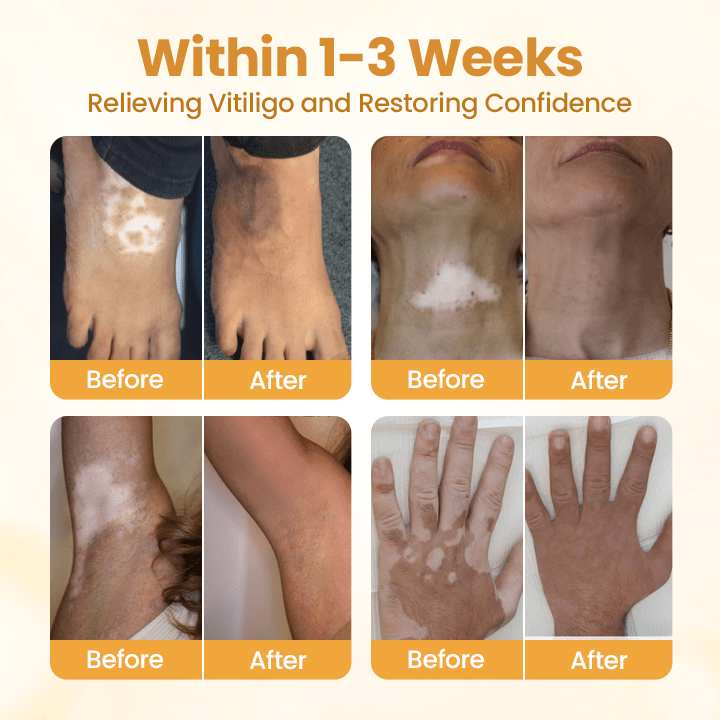 VitiClear Pro Bee Toxin Cream