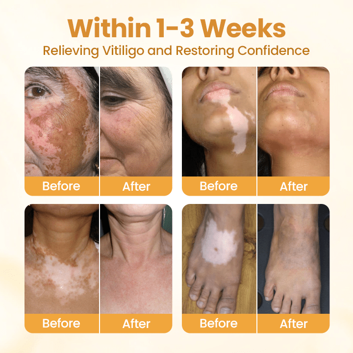 VitiClear Pro Bee Toxin Cream