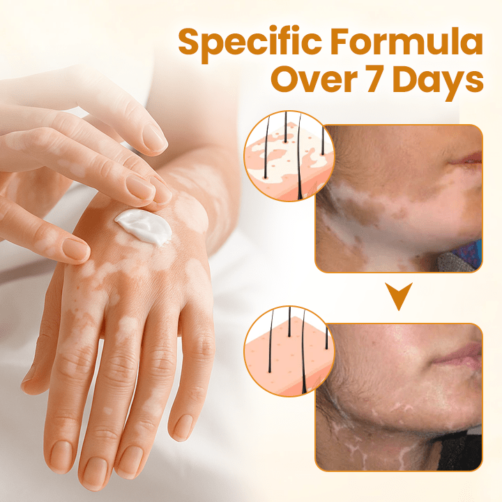 VitiClear Pro Bee Toxin Cream