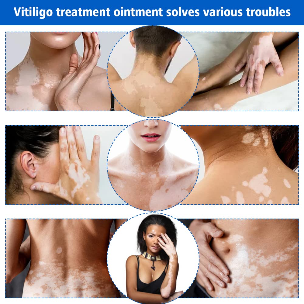 Fengyang Pack of 2 Vitiligo Skin Care Balm Vitiligo Cream Vitiligo Cream Vitiligo Cream for White Spots on the Skin Vitiligo Care Cream