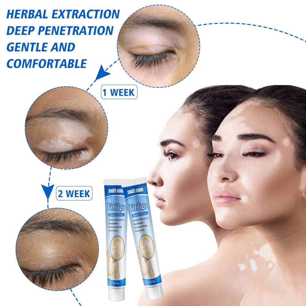 Fengyang Pack of 2 Vitiligo Skin Care Balm Vitiligo Cream Vitiligo Cream Vitiligo Cream for White Spots on the Skin Vitiligo Care Cream