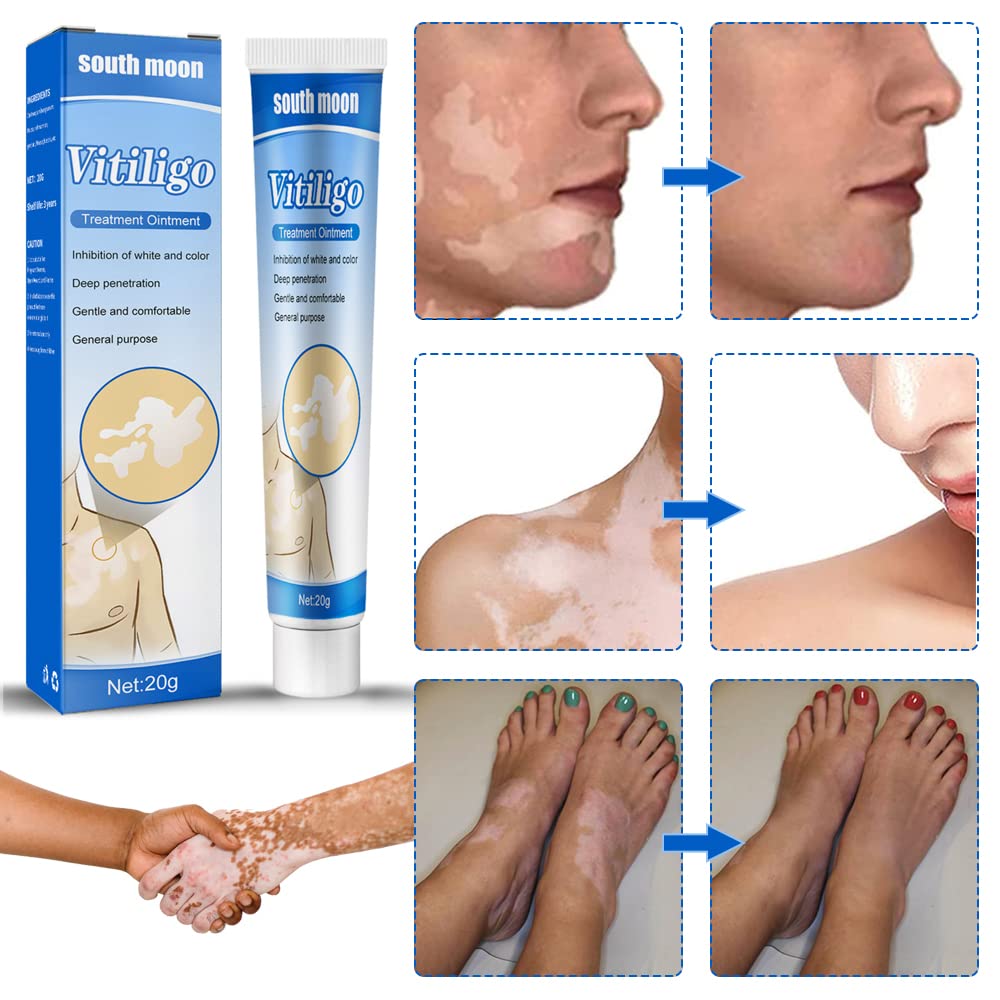 Fengyang Pack of 2 Vitiligo Skin Care Balm Vitiligo Cream Vitiligo Cream Vitiligo Cream for White Spots on the Skin Vitiligo Care Cream