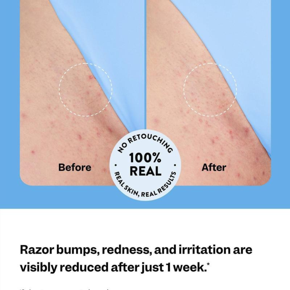 Smoothing Solution Ingrown Hair Treatment