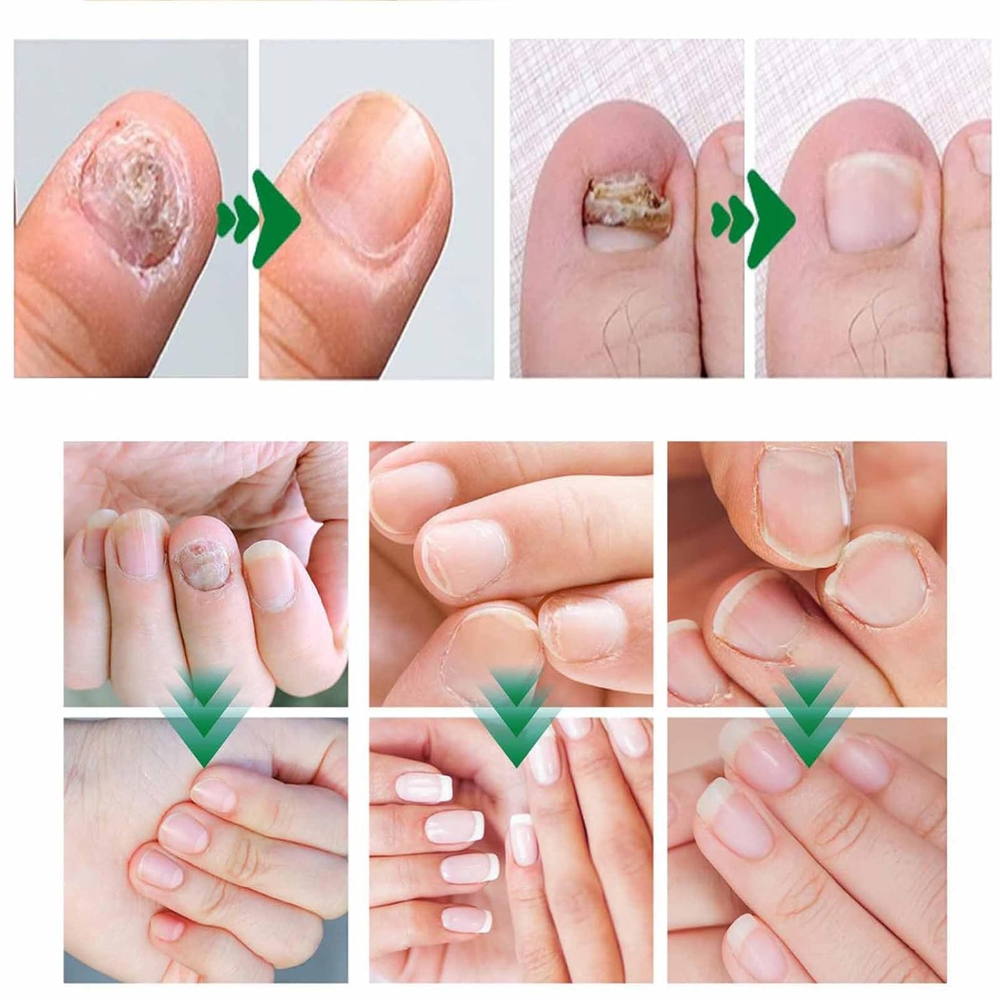 Natural Nail Fungus Treatment Gel - Fungus Cream, Multi-Purpose Nail Repair
