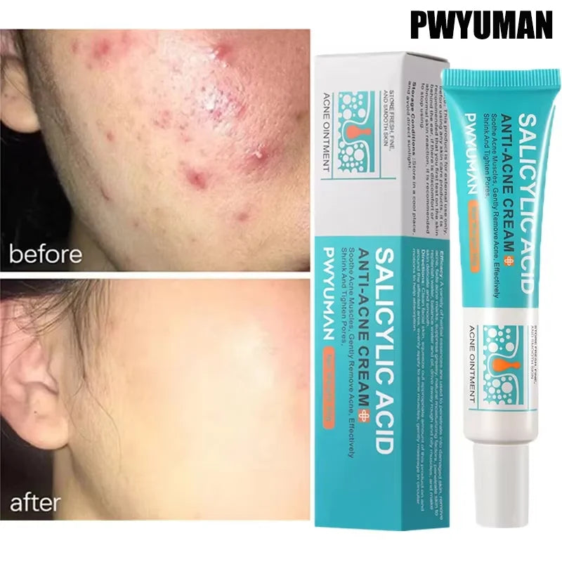 Salicylic Acid Blemish Gel Cream