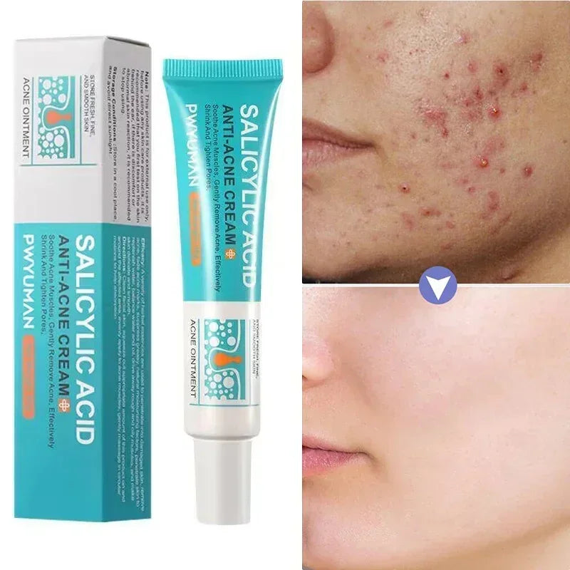 Salicylic Acid Blemish Gel Cream